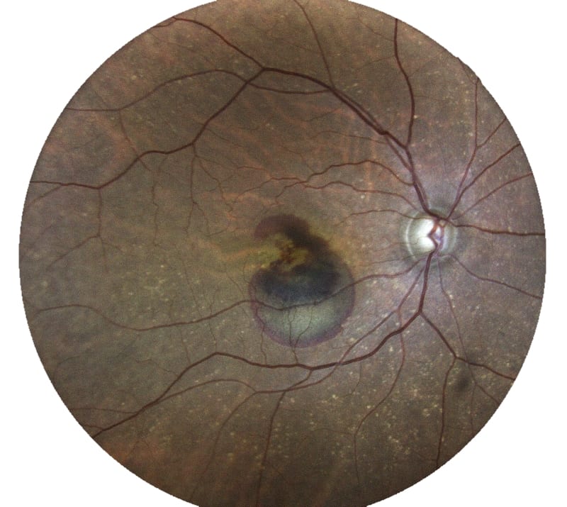 Read more about the article ניוון רשתית (AMD)